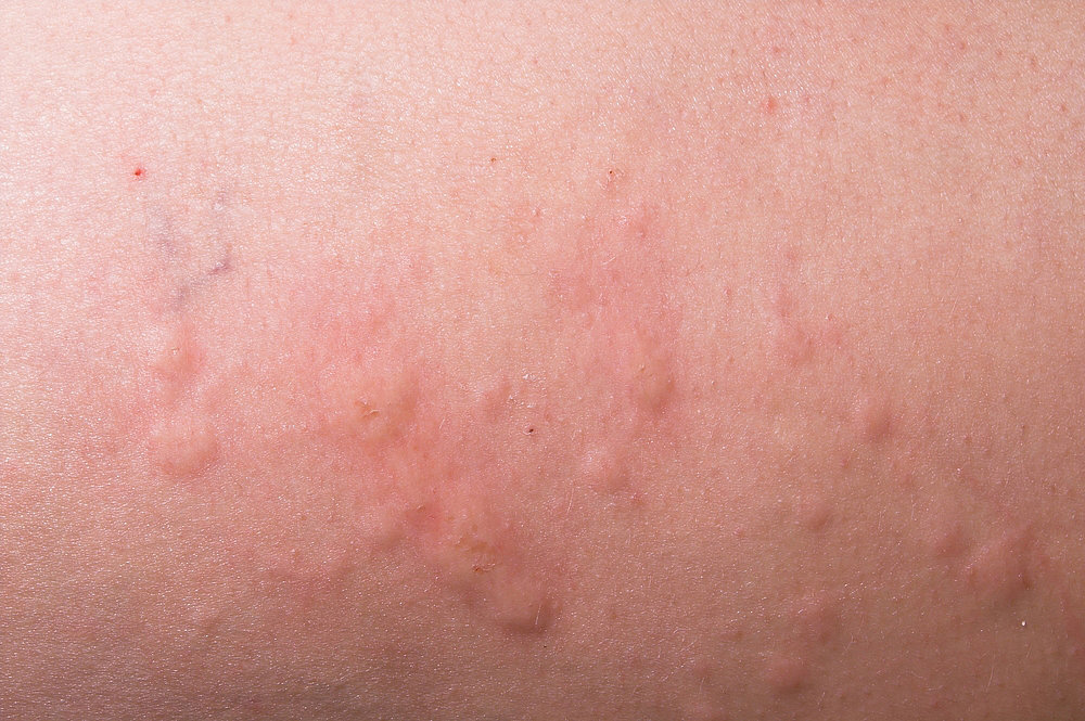 Hives Clear Up These Common Children s Skin Conditions POPSUGAR Moms