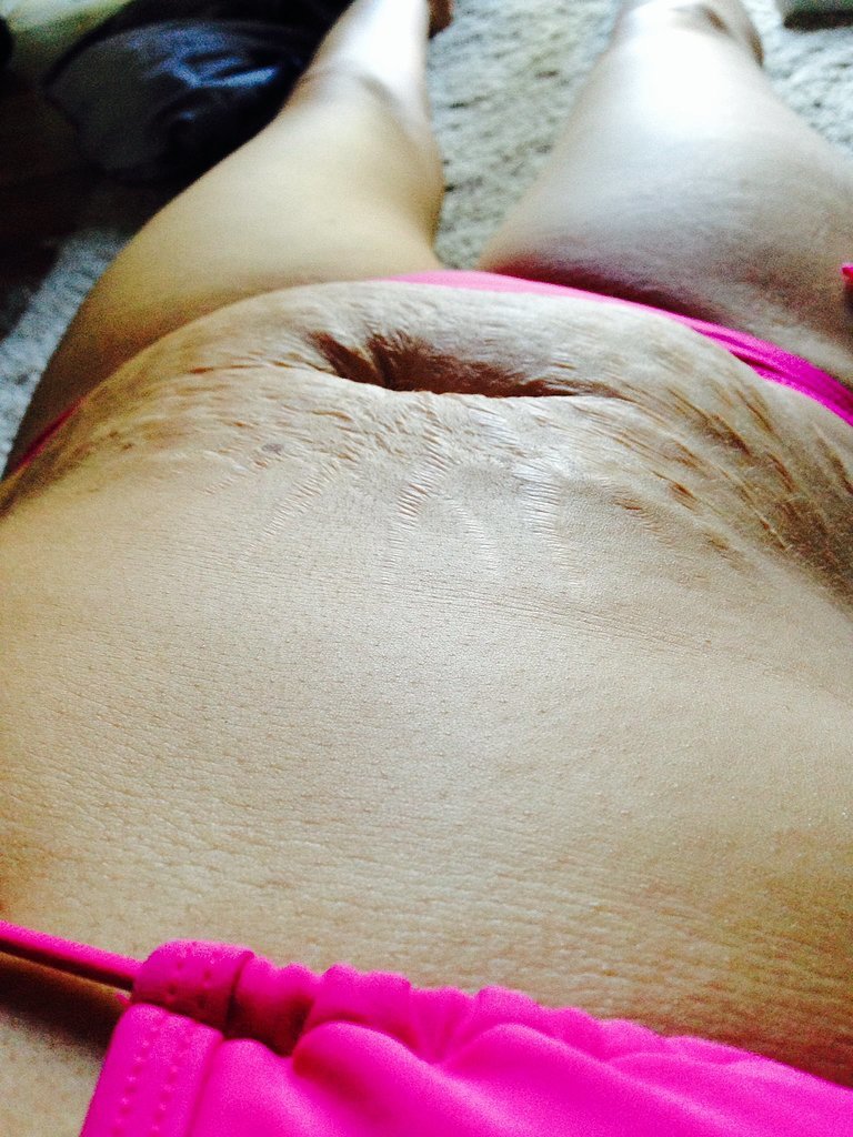 Recently, mother of five Tanis Jex-Blake uploaded this photo along with an open letter to a group of people who she said made fun of her while she was relaxing on the beach. In her Facebook post, Tanis writes, "I'm sorry if my first attempt at sun tanning in a bikini in public in 13 years 'grossed you out'. I'm sorry that my stomach isn't flat and tight. I'm sorry that my belly is covered in stretch marks. I'm NOT sorry that my body has housed, grown, protected, birthed and nurtured FIVE fabulous, healthy, intelligent and wonderful human beings. I'm sorry if my 33 year old, 125 lb body offended you so much that you felt that pointing, laughing, and pretending to kick me. But I'll have you know that as I looked at your 'perfect' young bodies, I could only think to myself 'what great and amazing feat has YOUR body done?'."
Recently, mother of five Tanis Jex-Blake uploaded this photo along with an open letter to a group of people who she said made fun of her while she was relaxing on the beach. In her Facebook post, Tanis writes, "I'm sorry if my first attempt at sun tanning in a bikini in public in 13 years 'grossed you out'. I'm sorry that my stomach isn't flat and tight. I'm sorry that my belly is covered in stretch marks. I'm NOT sorry that my body has housed, grown, protected, birthed and nurtured FIVE fabulous, healthy, intelligent and wonderful human beings. I'm sorry if my 33 year old, 125 lb body offended you so much that you felt that pointing, laughing, and pretending to kick me. But I'll have you know that as I looked at your 'perfect' young bodies, I could only think to myself 'what great and amazing feat has YOUR body done?'."