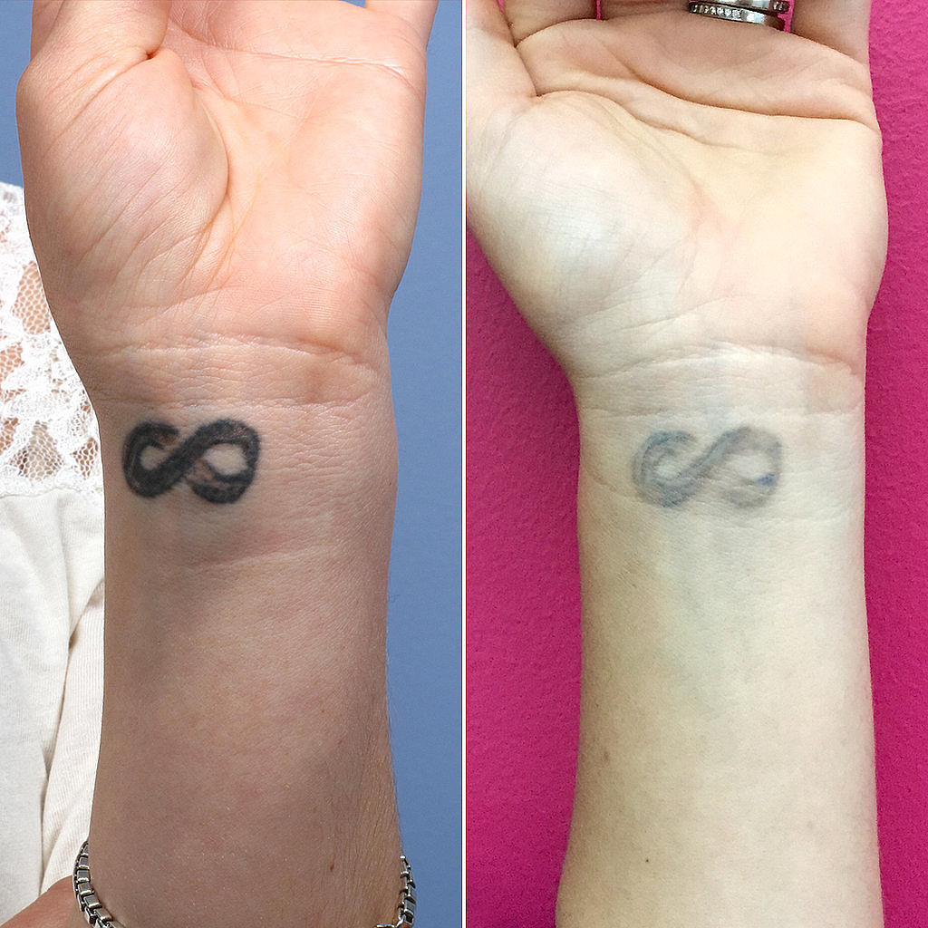 POPSUGAR gritar: O que acontece quando você se arrepende de sua tatuagem - beleza... POPSUGAR gritar: O que acontece quando você se arrepende de sua tatuagem - beleza...